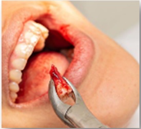 Wishdom Tooth Extraction